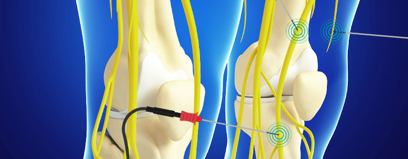 patient receiving Genicular Nerve Ablation in Garland for auto accident injury pain relief