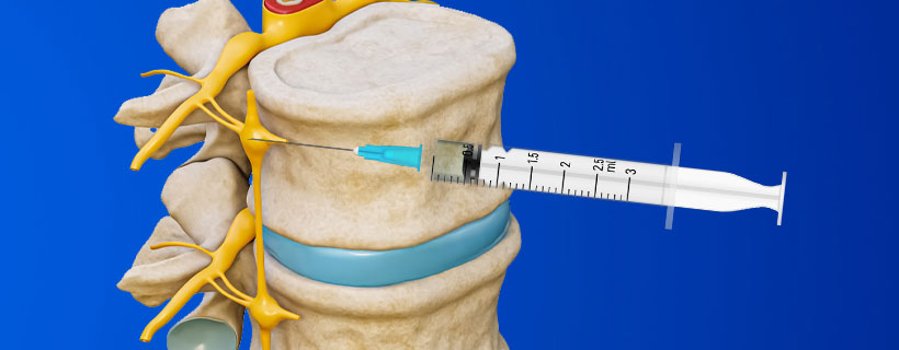 patient receiving Lumbar Sympathetic Block in Garland for auto accident injury pain relief