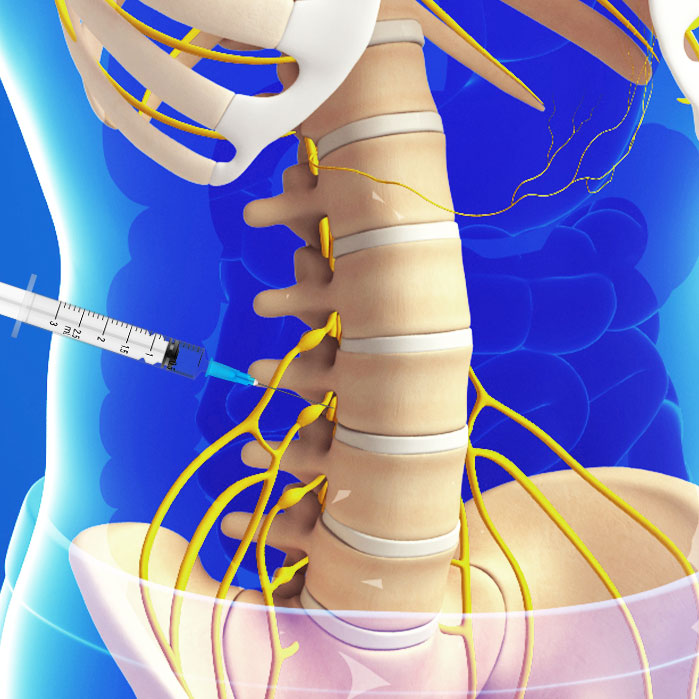 lumbar transforaminal epidural steroid injections in Garland