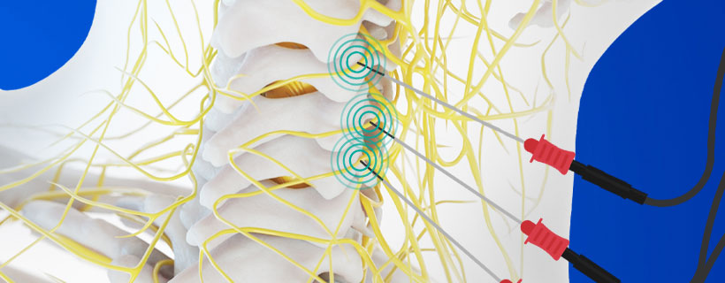patient receiving Radiofrequency Neurotomy in Garland for auto accident injury pain relief